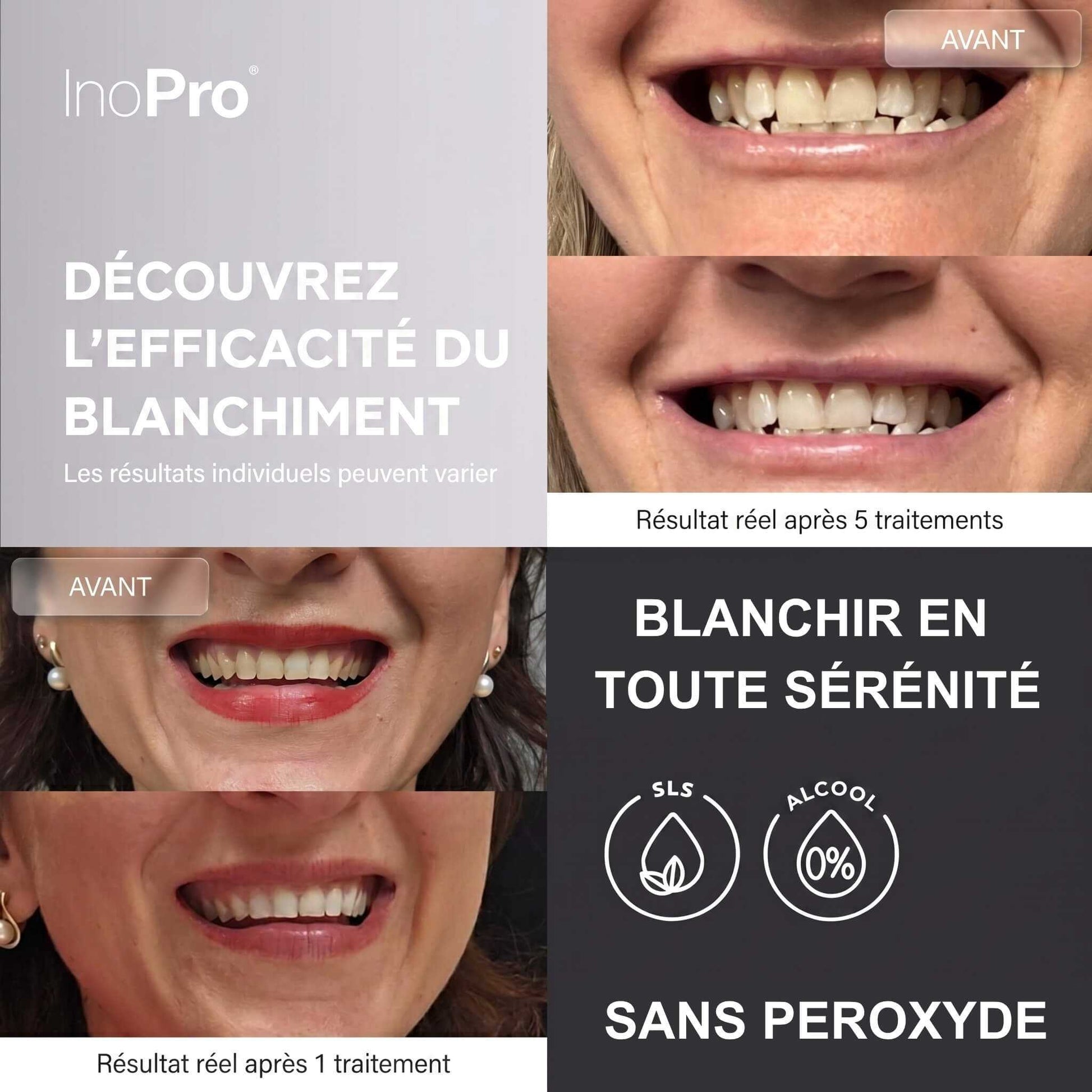 Résultats avant/après des bandes de blanchiment dentaire INOPRO sans peroxyde, après 1 et 5 traitements