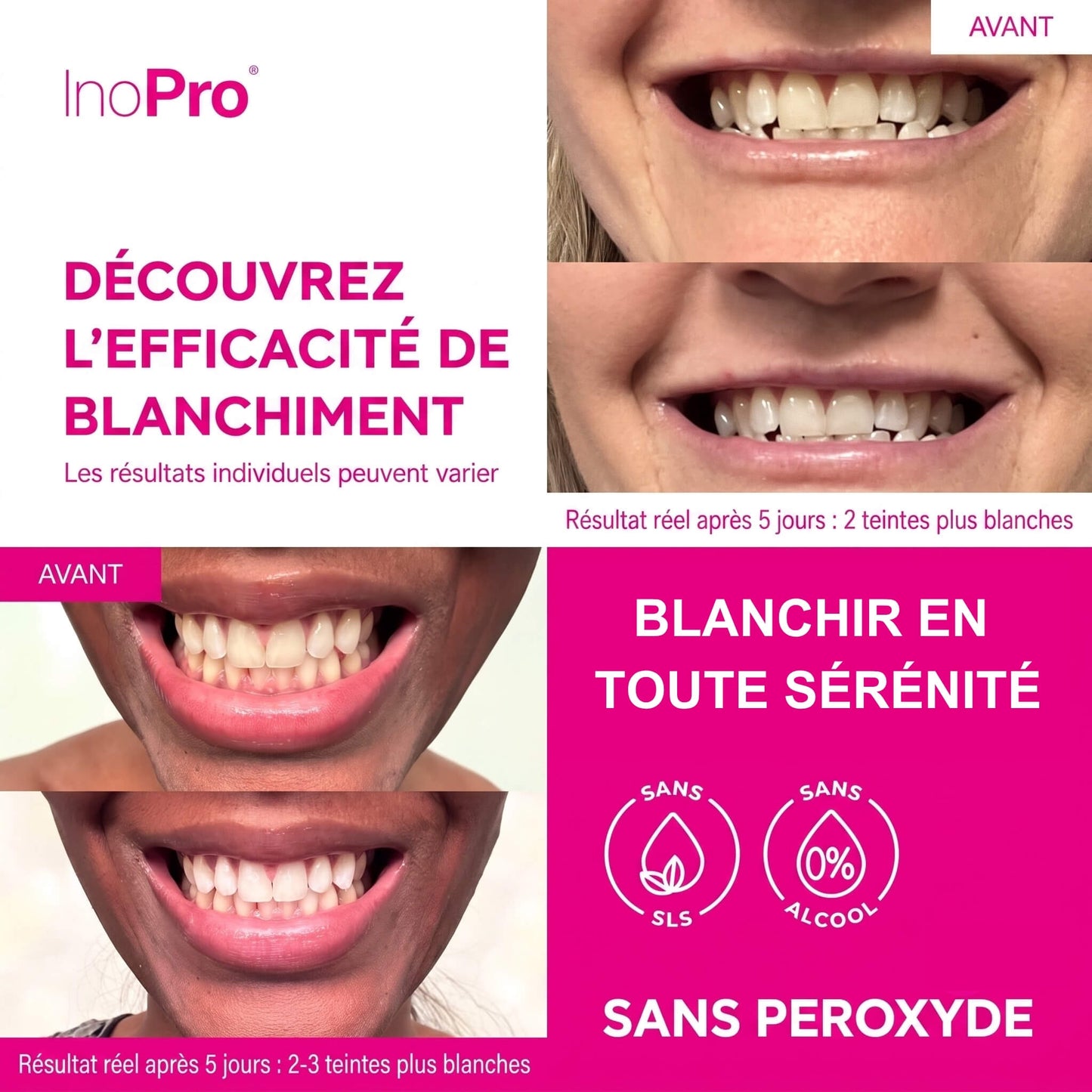 Résultats avant/après bandes de blanchiment INOPRO Innovative - sans peroxyde